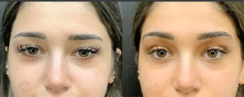 Fillers Before and After Pictures Detroit, MI