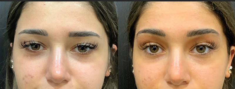 Fillers Before and After Pictures Detroit, MI