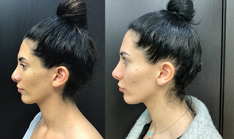 Nose Filler Before and After Pictures Detroit, MI