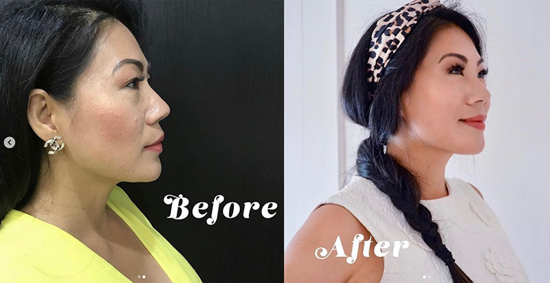 Ultherapy Before and After Pictures Detroit, MI