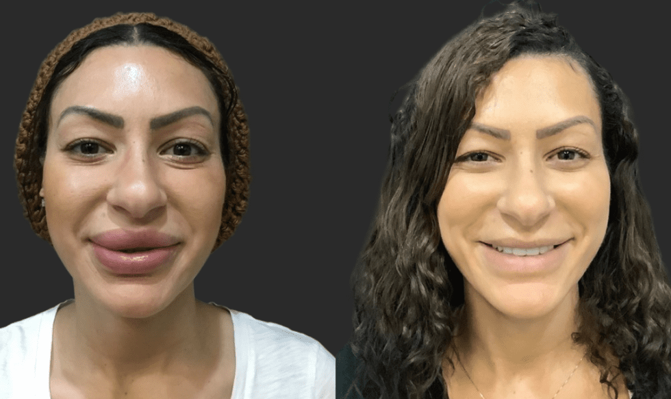 Silicone Lip Removal Before and After Pictures BOYD