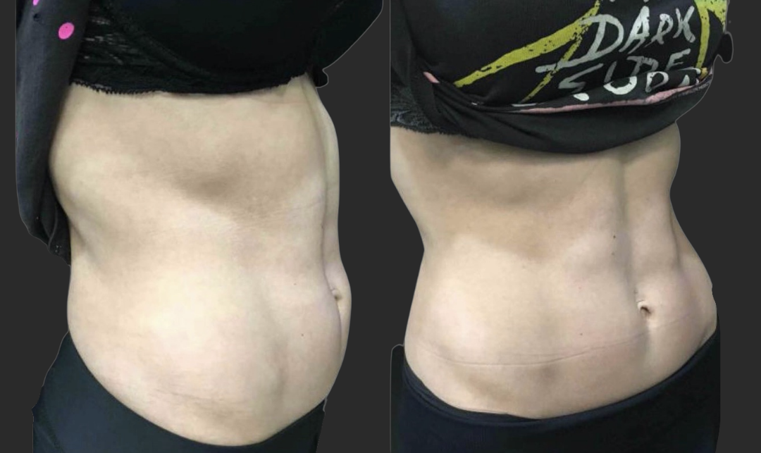 Emsculpt Before and After Pictures