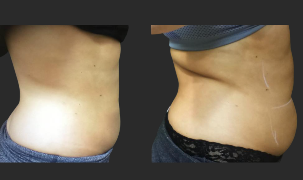 Coolsculpting Before and After Pictures