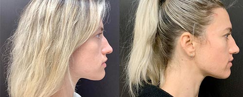 Liquid Rhinoplasty Before and After Pictures Detroit, MI