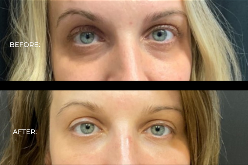 Fillers Before and After Pictures Detroit, MI