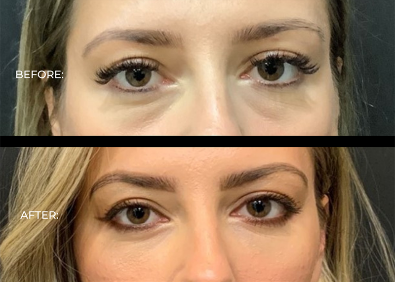 Fillers Before and After Pictures Detroit, MI