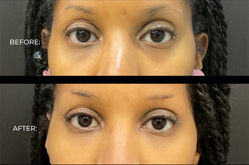 Fillers Before and After Pictures Detroit, MI