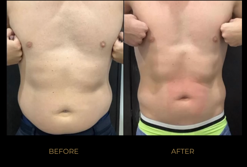 EmSculpt NEO Before and After Pictures BOYD