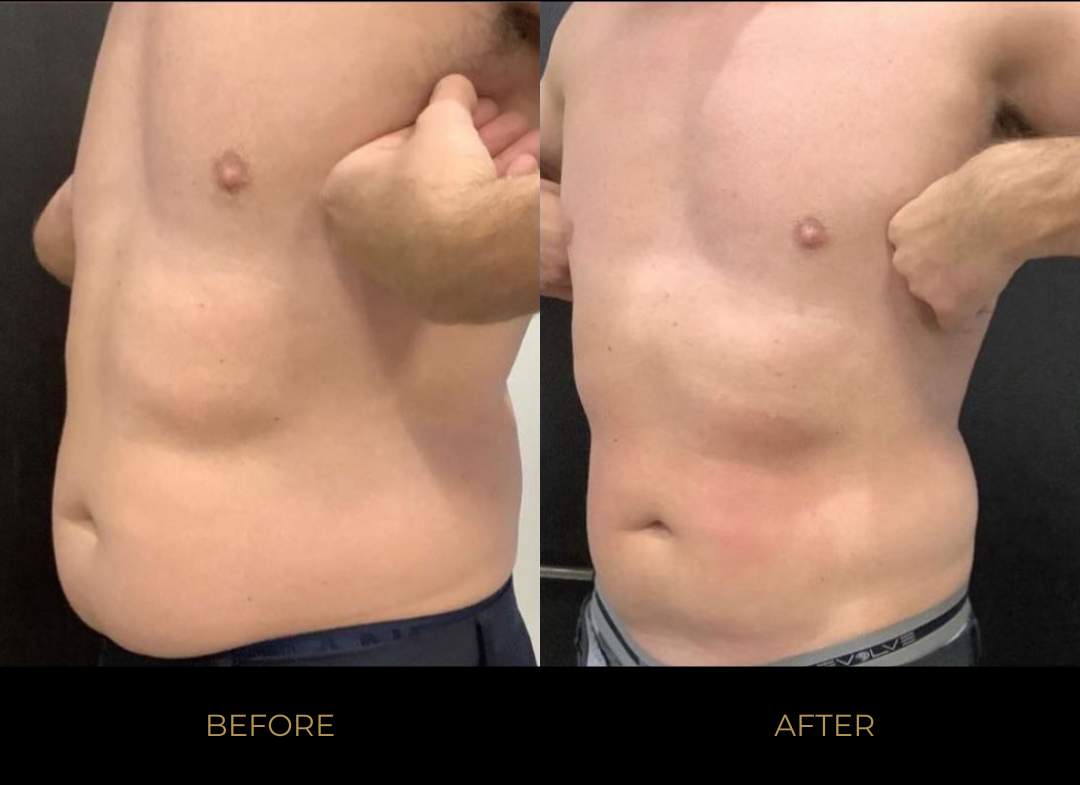 EmSculpt NEO Before and After Pictures