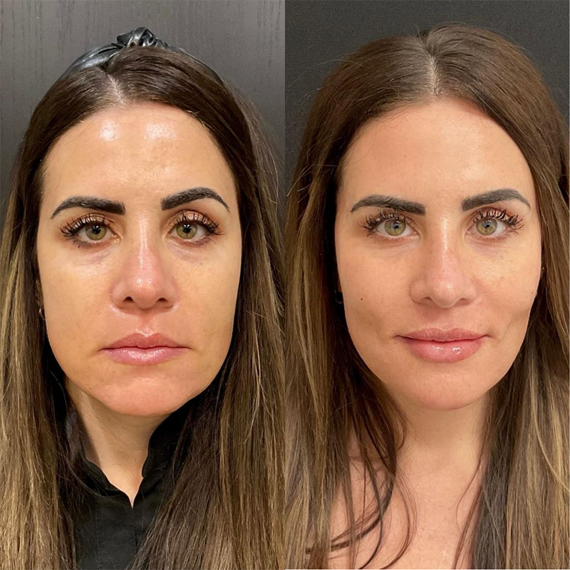 Fillers Before and After Pictures Detroit, MI