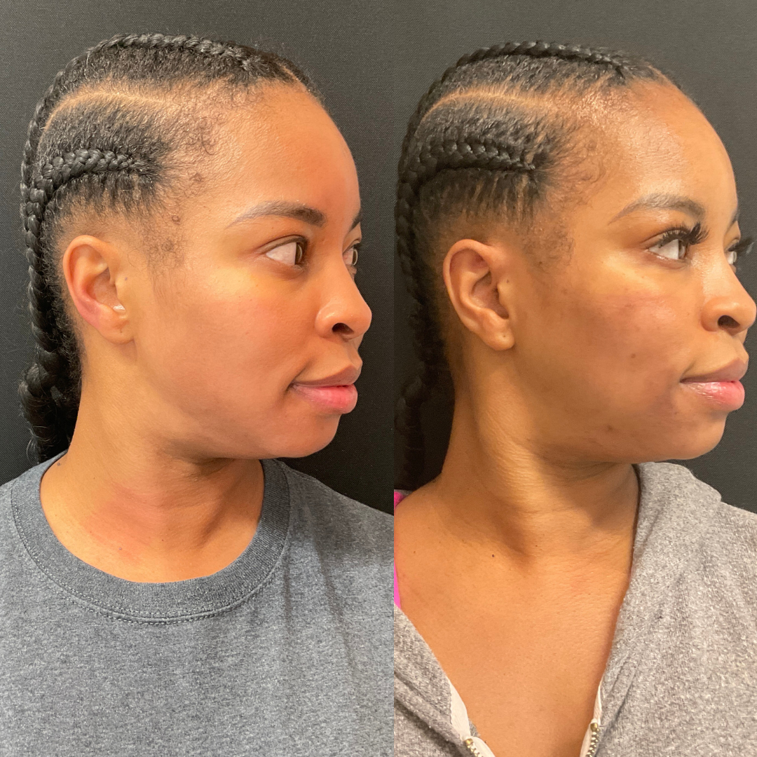 Fillers Before and After Pictures Detroit, MI