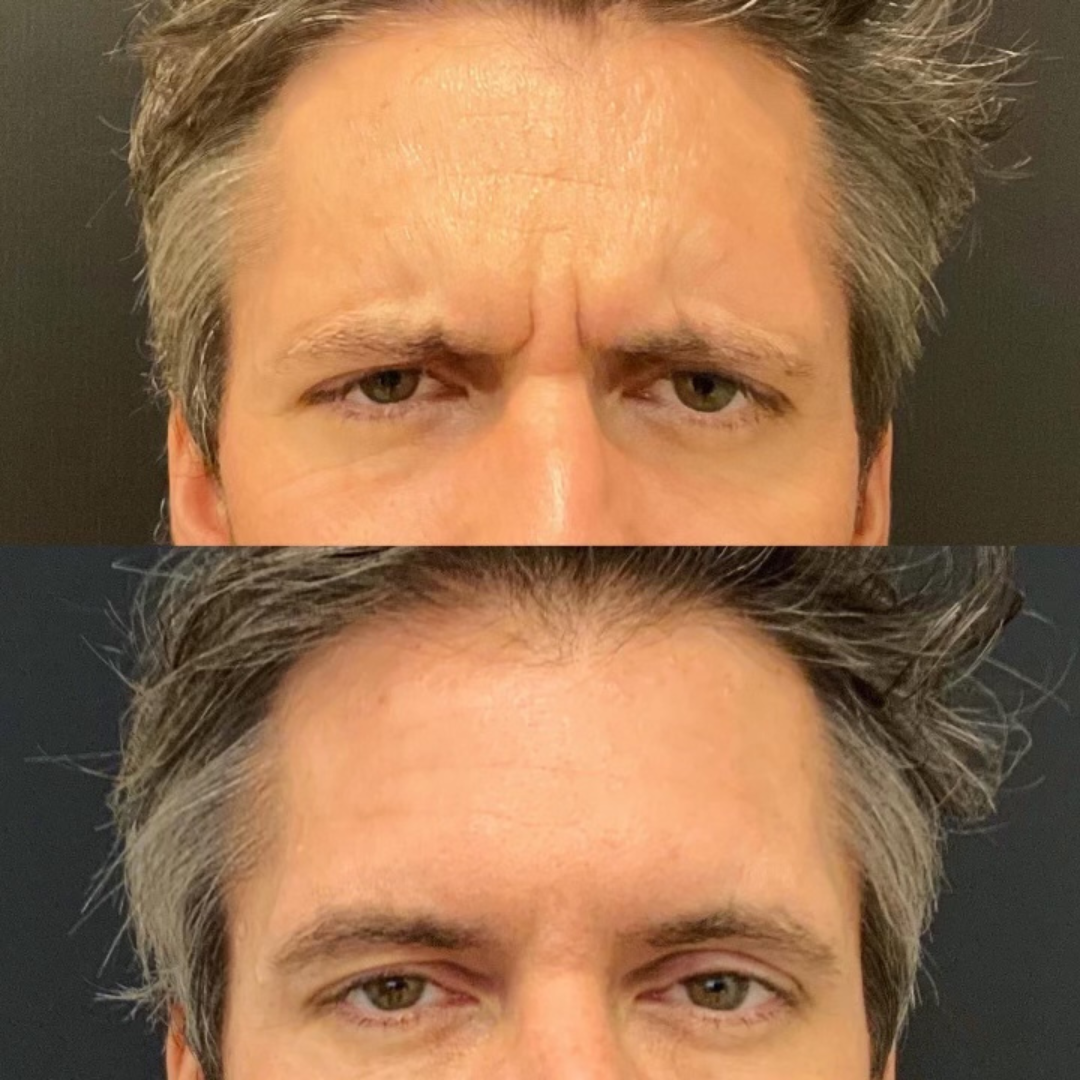 Fillers Before and After Pictures Detroit, MI