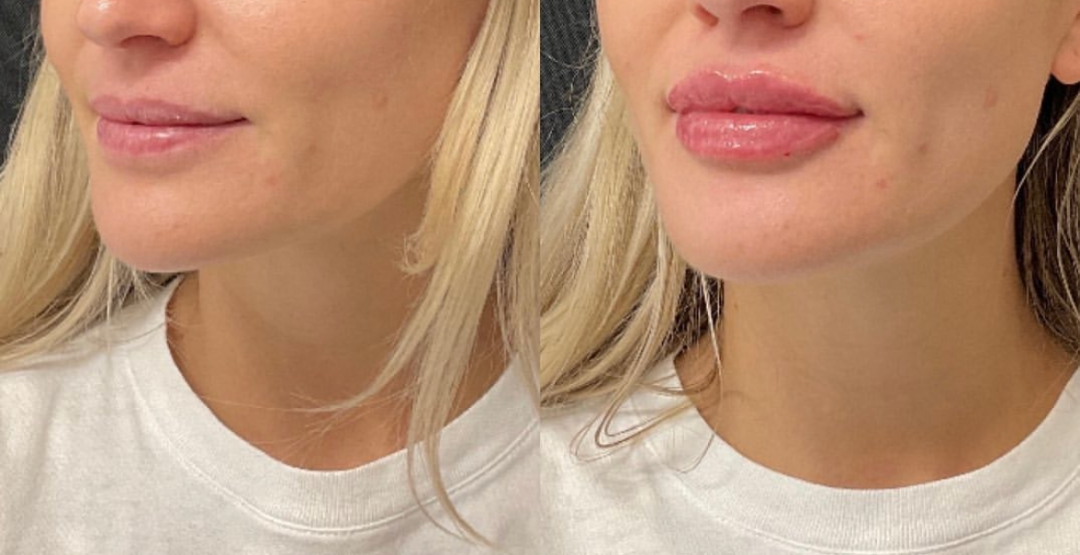 Fillers Before and After Pictures Detroit, MI