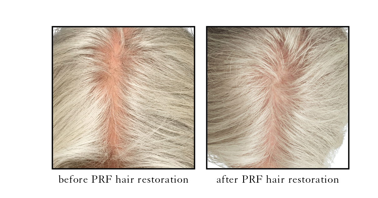 Before and after PRF hair at RegenCen