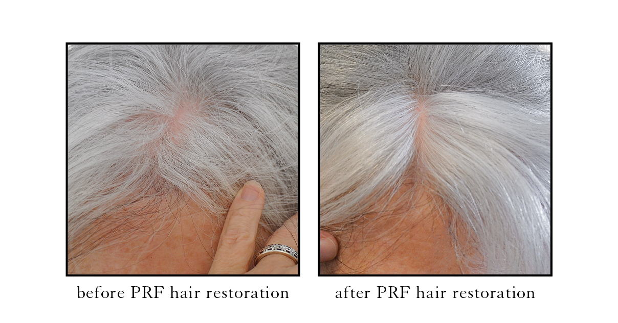 Before and after PRF / PRP hair treatment at BOYD