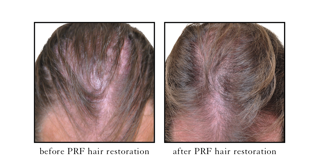 Before and after hair restoration at RegenCen