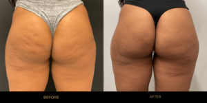 Aveli Before and After 