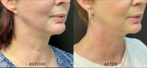Dermal Fillers Before and After Pictures