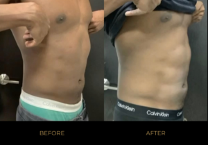 Emsculpt NEO Before and After