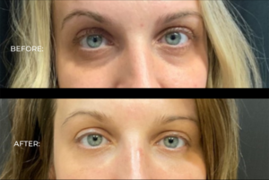 Under eye filler before and after results 