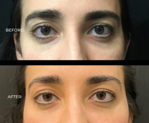 Tear Trough Filler results 
