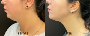 Dermal Filler Before and After Pictures