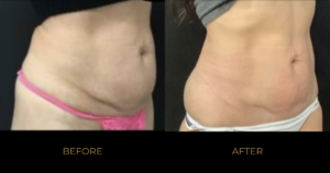 Emsculpt NEO before and after