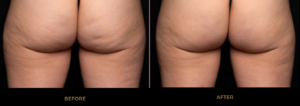 Avéli Before and After Results