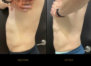 Emsculpt NEO before and after