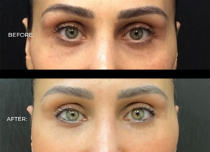 Under eye filler results 
