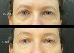 Under eye filler results 
