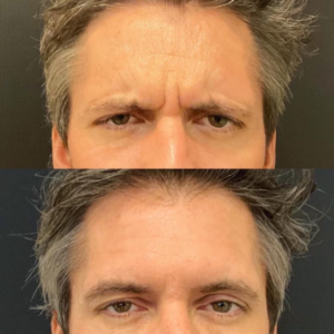 Before and after natural Botox results 