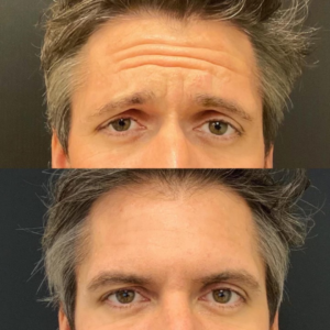 Daxxify Before and After results 