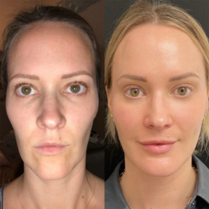 Facial Balancing natural results 