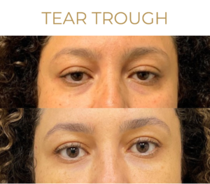 Tear Trough Filler Before and After