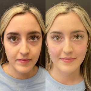 Tear Trough Before and After Pictures