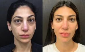 Under eye filler before and after results 