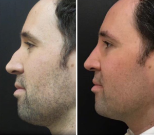 Liquid Rhino Before and After Pictures