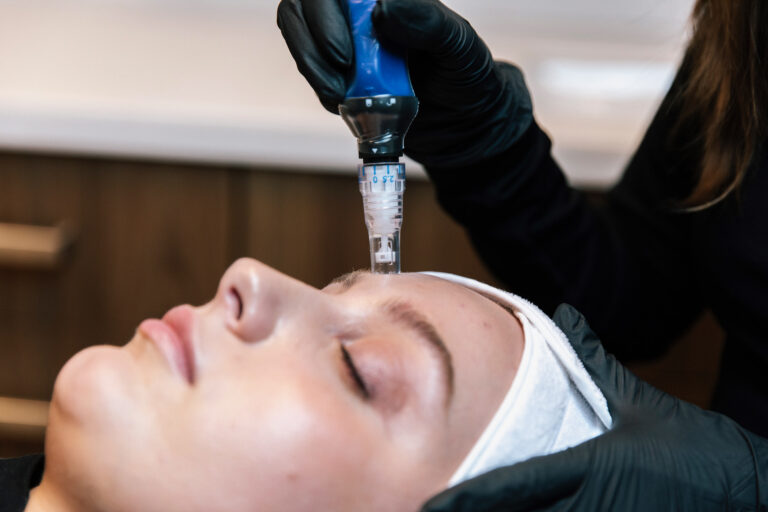 Microneedling skin treatment at BOYD Microneedling skin treatment at BOYD